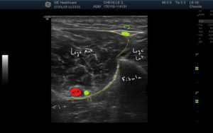 i-ALR Sono-anatomie Cheville